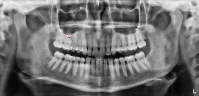 ¿Por qué tengo dientes de más y qué son los supernumerarios?